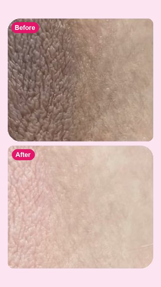 نتيجة قبل وبعد مع Bikini Butter
