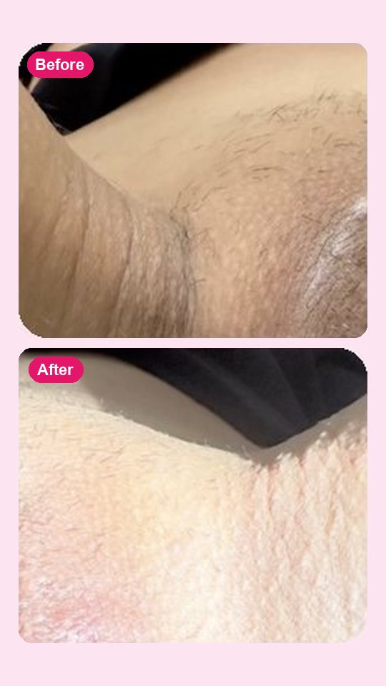 نتيجة قبل وبعد مع Bikini Butter