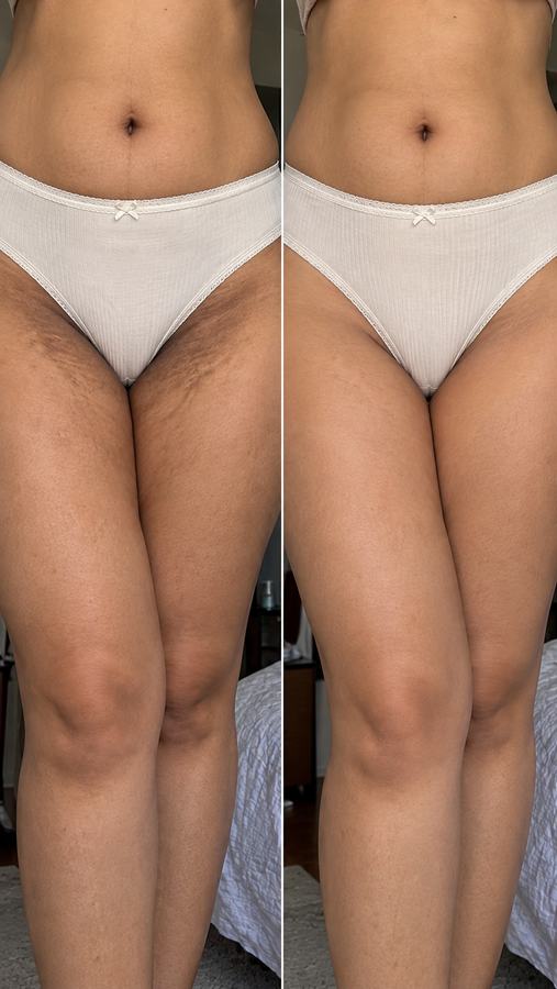 نتيجة قبل وبعد مع Bikini Butter