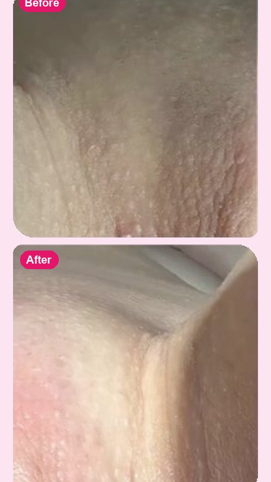 نتيجة قبل وبعد مع Bikini Butter